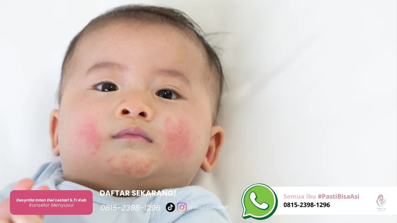 Biang Keringat pada Bayi: Penyebab dan 6 Cara Mengatasinya Agar Kulit Mulus | Bisa ASI biang keringat pada bayi penyebab dan 6 cara mengatasinya agar kulit mulus bisa asi